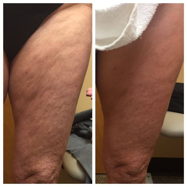 Cellulite Reduction