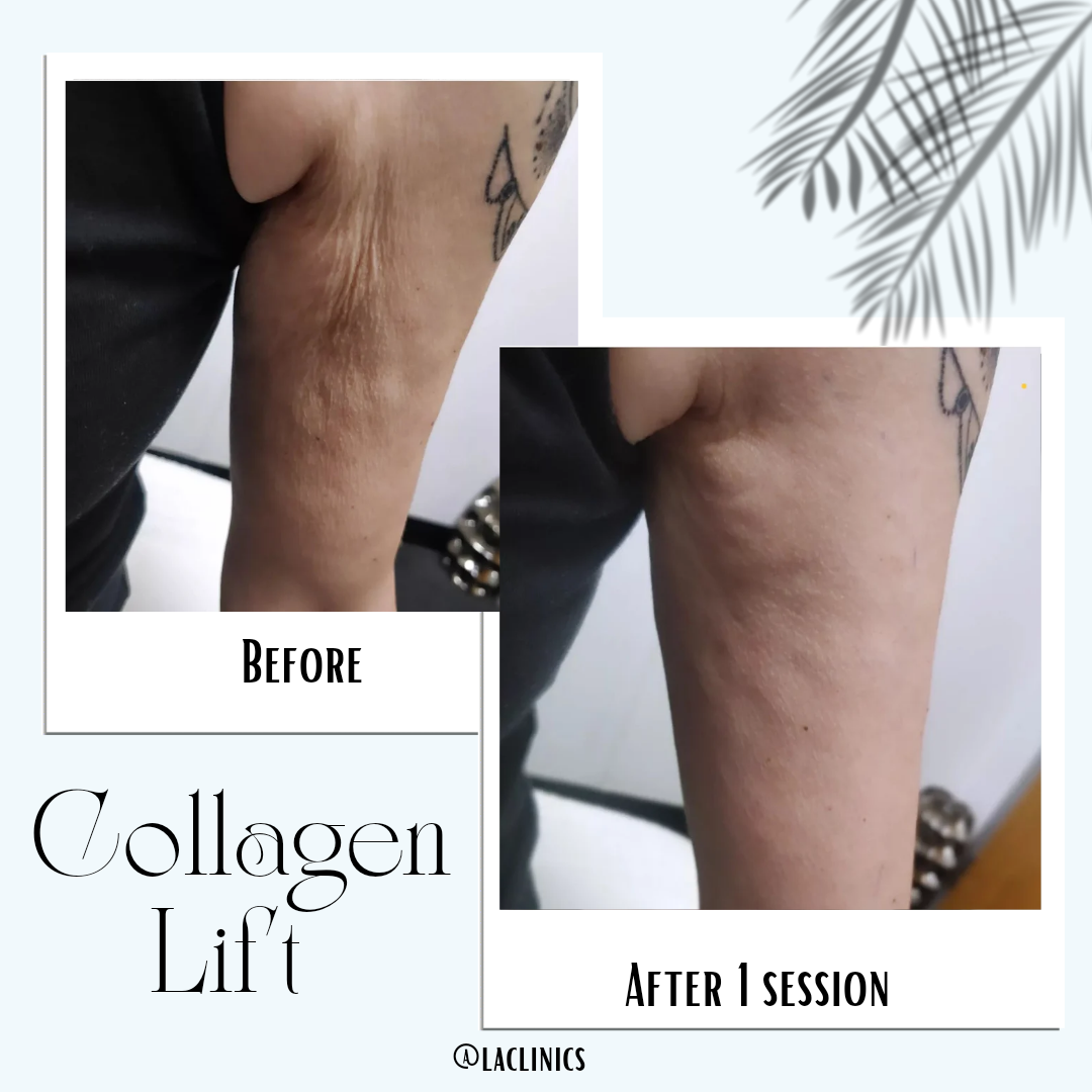 Collagen Lift on arms