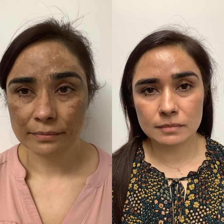 Skin Resurfacing and pigmentation reduction.