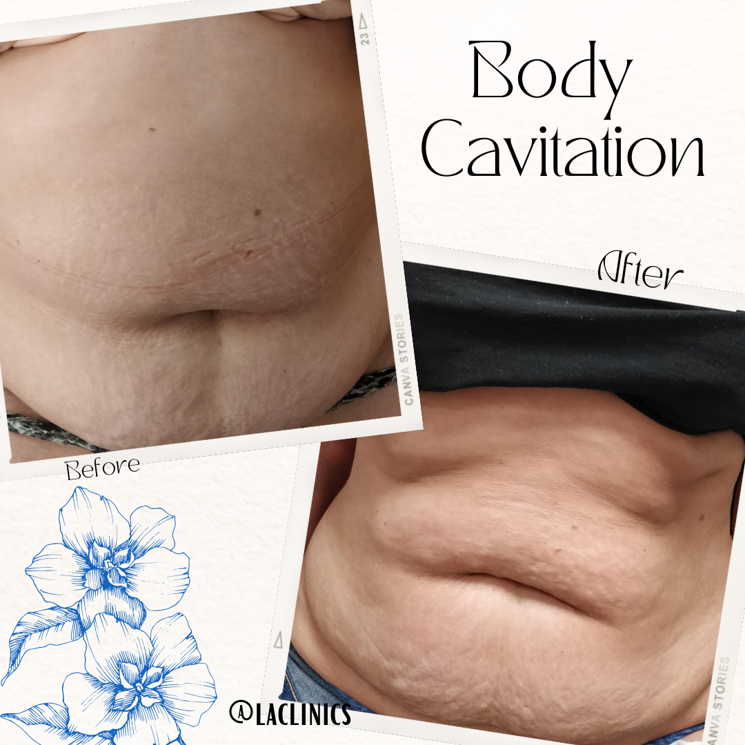 4 sessions of Cavitation on the full stomach area, and Shockwave